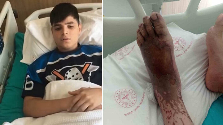 14 Yaşındaki Çocuğun Ayakları Asit Çamuruna Basınca Yandı